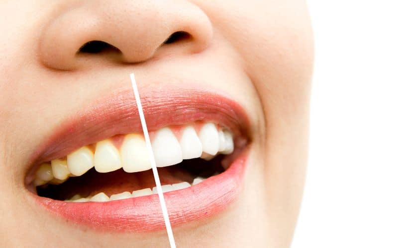 Featured image for “Teeth Whitening-The Basics And How To Make It Work”