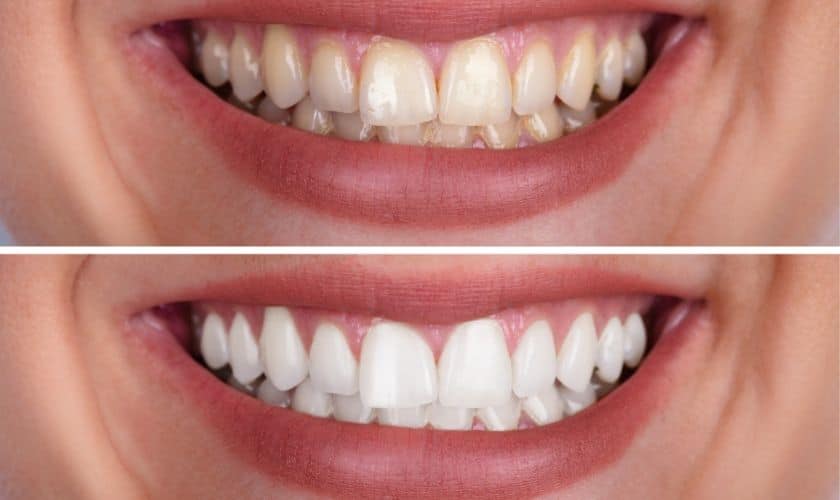 Featured image for “Teeth Whitening in Fort Walton Beach: Brightening Smiles and Confidence”