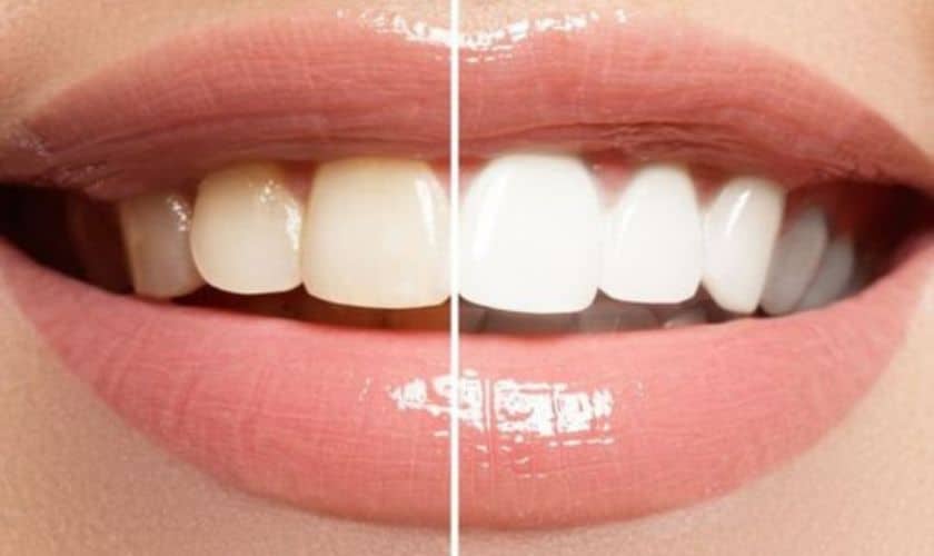 Featured image for “Sensitive Teeth and Teeth Whitening: How to Minimize Discomfort”