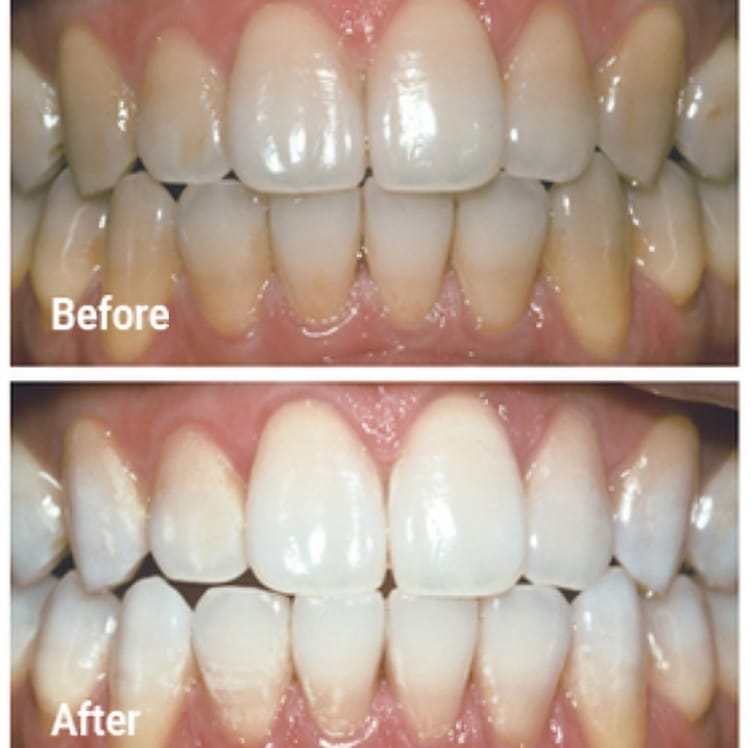 Before and after dental whitening results showing teeth transformation from yellow to bright white.