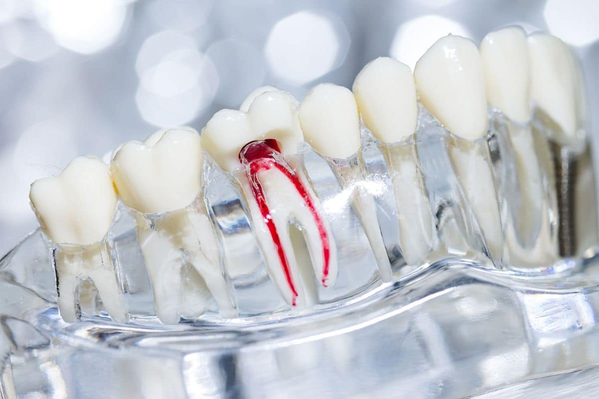 Featured image for “Root Canal Therapy Myths: What Your Dentist Wants You to Know”