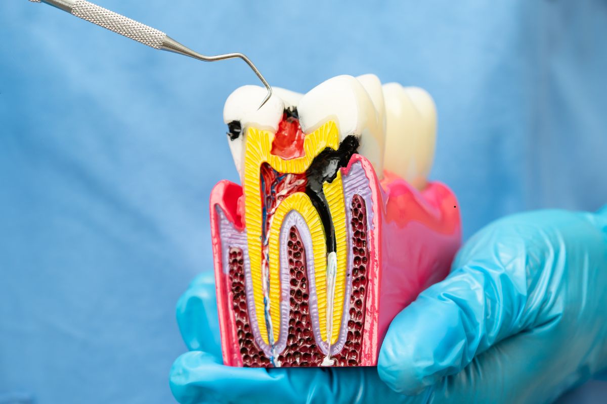 Featured image for “Debunking Common Myths About Root Canal Therapy”