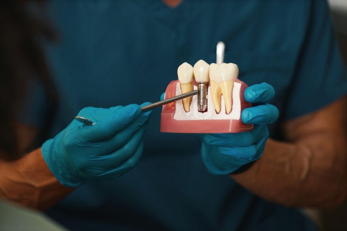 Featured image for “Top 10 Benefits of Choosing Dental Implants for Tooth Loss”