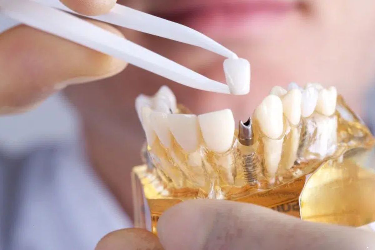Featured image for “Smile with Confidence Again — The Life-Changing Benefits of Dental Implants”