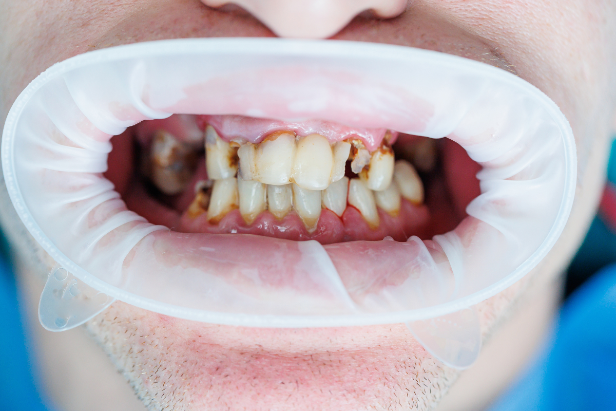 Featured image for “Knocked-Out or Broken Tooth? Acting Quickly Can Save Your Smile”